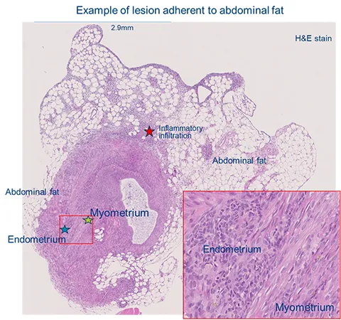 Endometriosis mouse model lesion histology with H&E stain