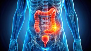 Predicting Clinical Success in Preclinical Inflammatory Gut Disease Research